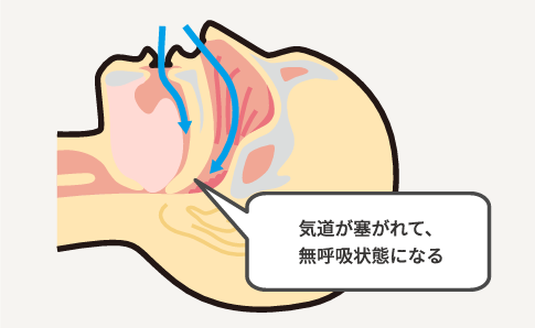 気道が塞がれて無呼吸状態になる図
